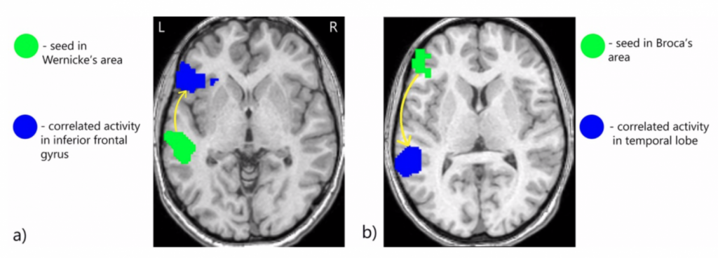 This is an image of a functional MRI scan of words being represented by the Broca's area and Wernicke's area, respectively.