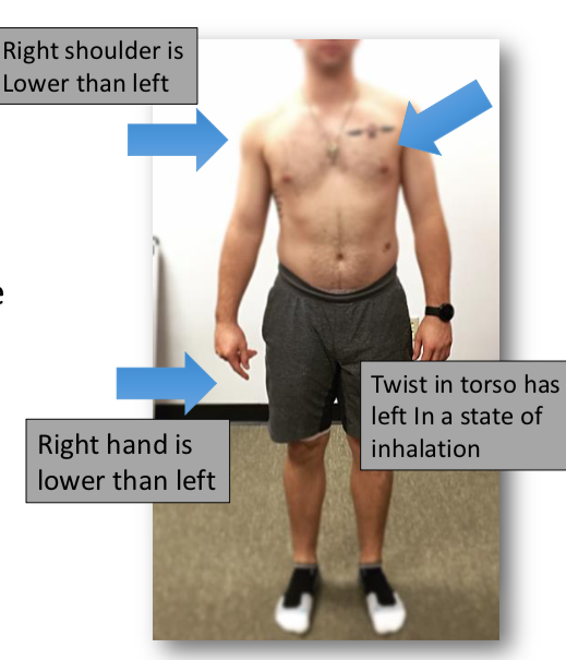 There is an asymmetry found in all individuals, and it is expressed in greater detail in athletes that play rotationally demanding sports.